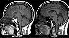 علاج التوحد والتخلف العقلى وضمور خلايا المخ بالخلايا الجذعية بنجاح ... - Image 1