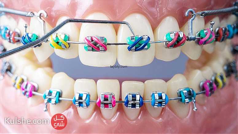 تقويم الاسنان - Image 1