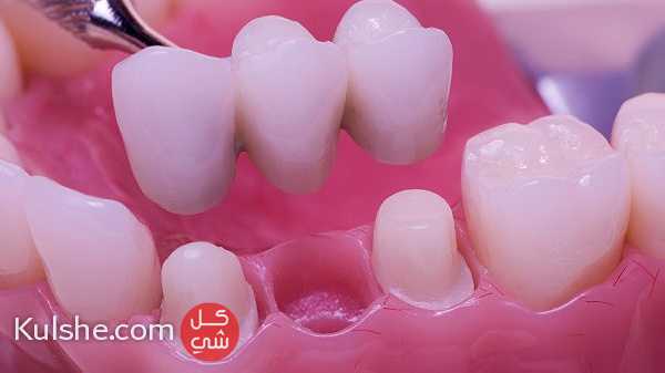 Dental Crown and Dental Bridge treatment in Dubai UAE - صورة 1