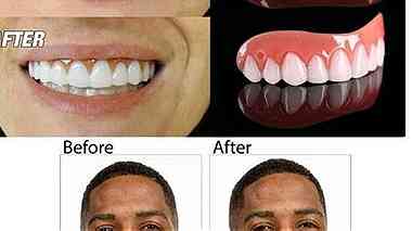 طقم اسنان مؤقت perfect smile ابتسامة هوليود مع منتج بيرفكت سمايل اسنان