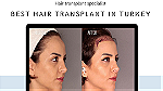 Hair transplant in Turkey - Image 1