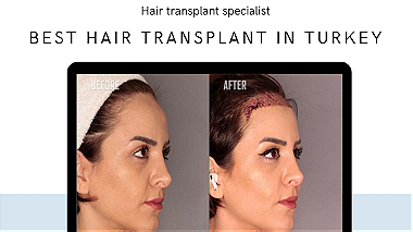 Hair transplant in Turkey