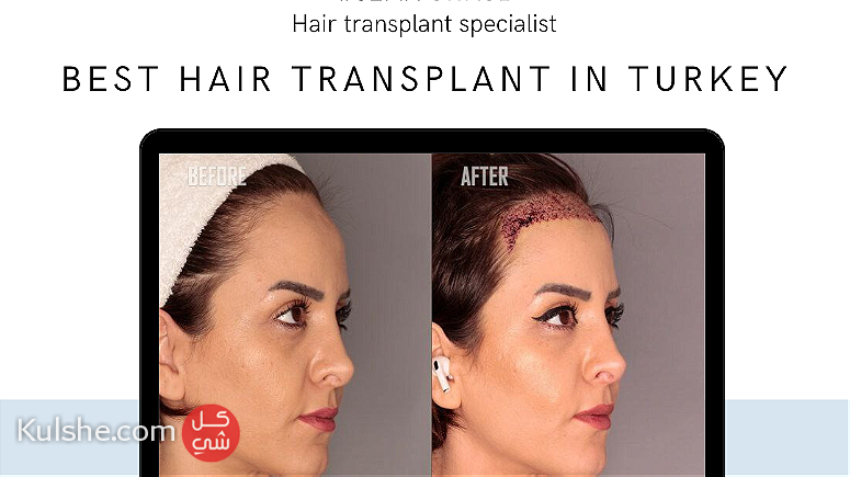 Hair transplant in Turkey - صورة 1