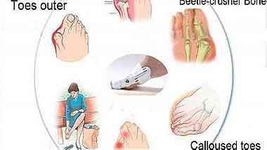 علاج انحراف إصبع القدم الكبير بدون جراحة للبيع في الاردن